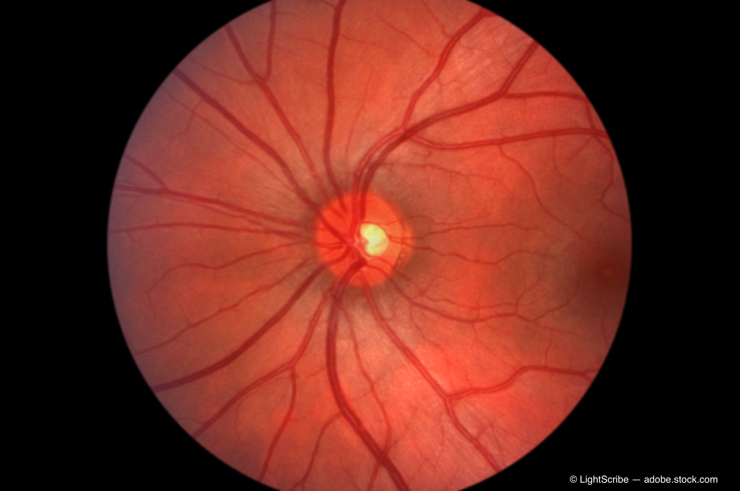 Mi is az a glaucoma?